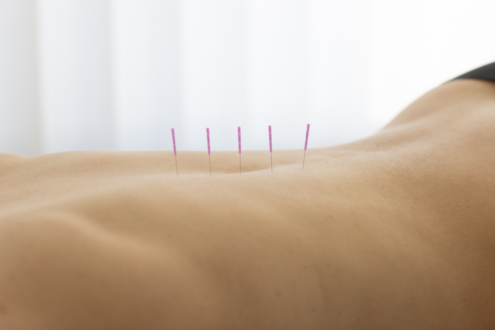 Akupunktur in Bonn:<br />
Kleine Nadeln, große Wirkung